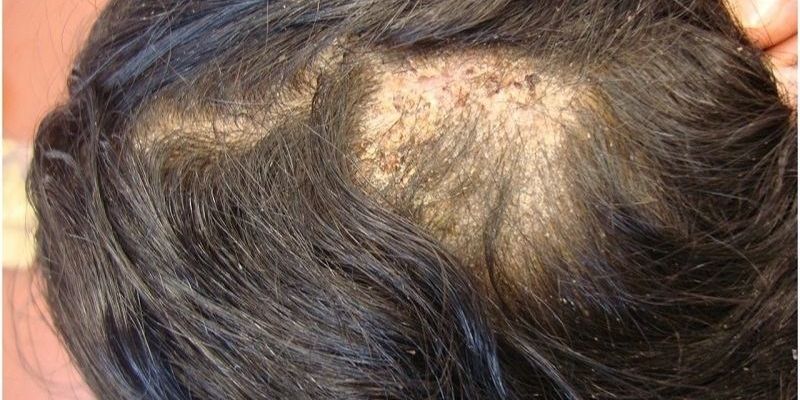 Nguyên Nhân Gây Bệnh Nấm Da Đầu Ở Người Lớn