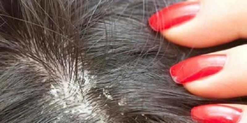 Triệu Chứng Của Bệnh Nấm Da Đầu