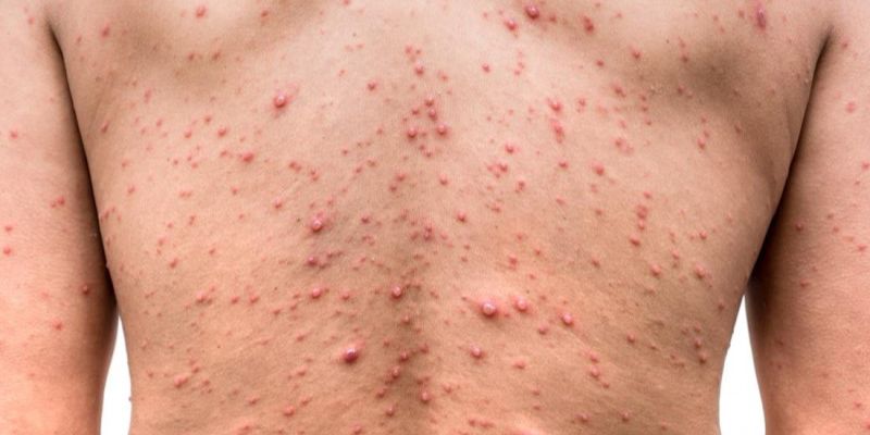 Tổng quan về bệnh thủy đậu