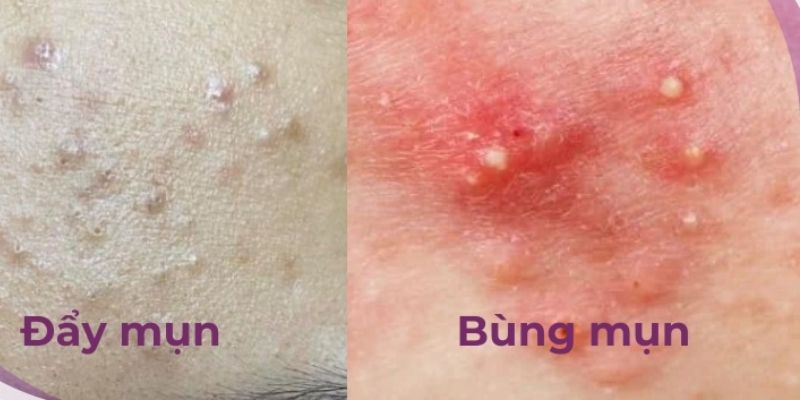 Phân biệt được đẩy mụn và bùng mụn