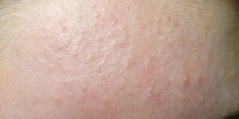 Làn da cần đẩy mụn