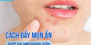 Cách đẩy nhân mụn an toàn và hiệu quả – Hướng dẫn chăm sóc da đúng cách