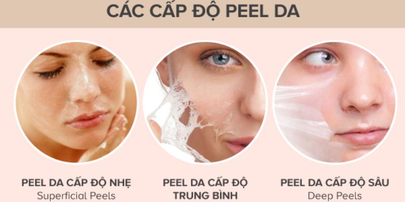 Các cấp độ peel da