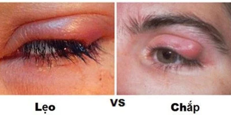 Nguyên Nhân Gây Chắp Và Lẹo Mắt