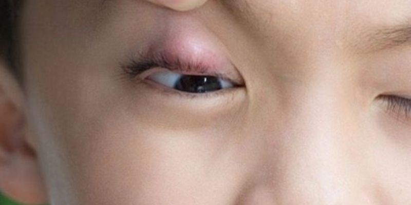 Cách Phòng Ngừa Chắp Và Lẹo Mắt
