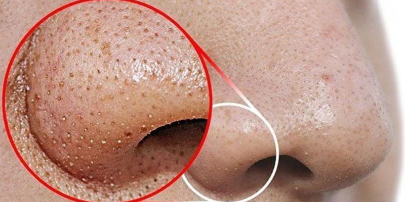 Cách Ngăn Ngừa Mụn Đầu Đen Ở Mũi