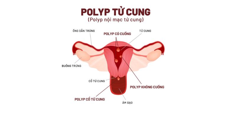 Polyp cổ tử cung là gì