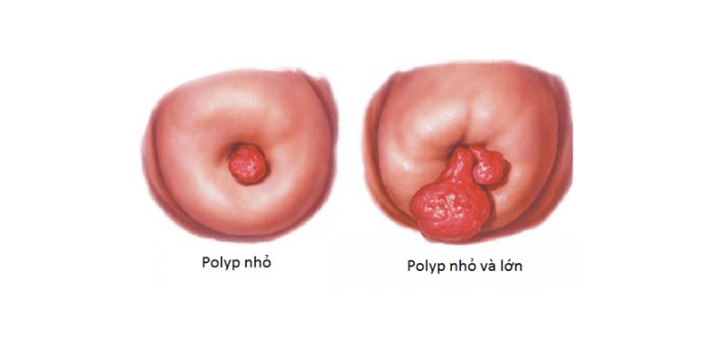 Triệu chứng nhận biết polyp cổ tử cung