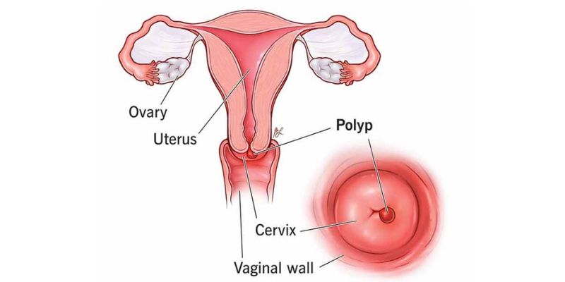 Nguyên nhân gây polyp cổ tử cung