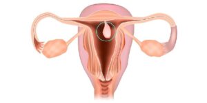 Nguyên nhân gây polyp cổ tử cung