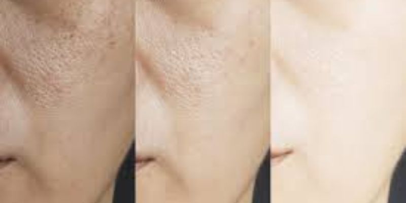 Nguyên Nhân Khiến Lỗ Chân Lông To