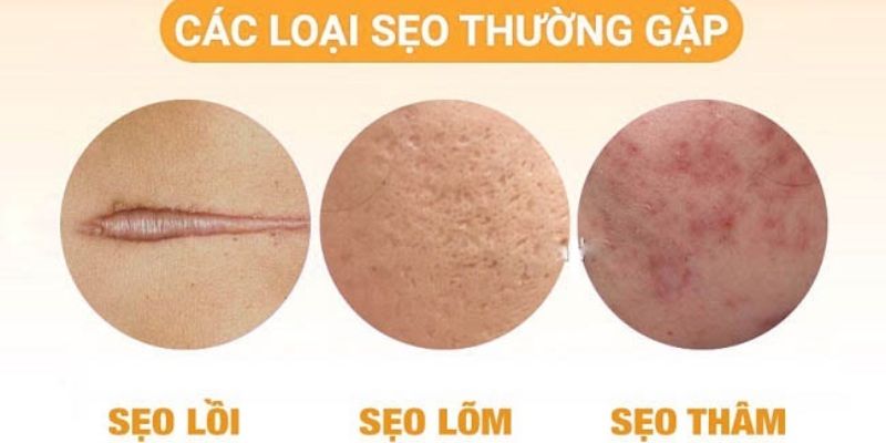Sẹo Thâm Là Gì