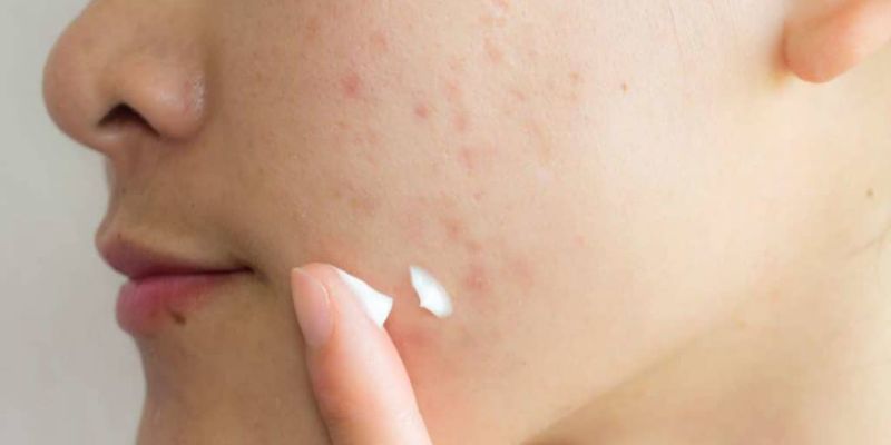 Cách Đẩy Nhanh Quá Trình Mờ Sẹo Thâm