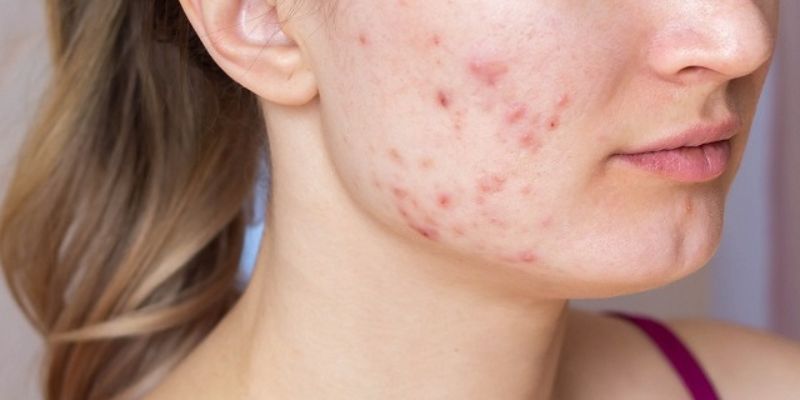 Sẹo Thâm Bao Lâu Sẽ Hết – Quá Trình Phục Hồi Da Và Cách Đẩy Nhanh Hiệu Quả