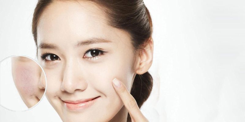 Trị Mụn Tận Gốc – Giải Pháp Hiệu Quả Cho Làn Da Sạch Mụn, Khỏe Mạnh