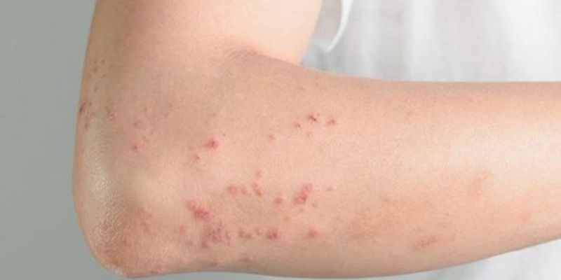 Viêm thành mạch dị ứng có nguy hiểm không