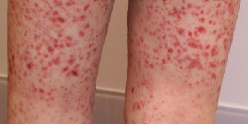 Nguyên nhân gây viêm thành mạch dị ứng