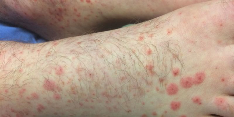 Viêm thành mạch dị ứng là gì