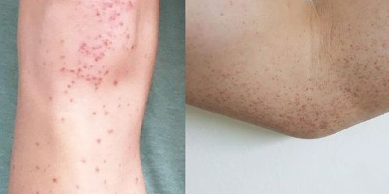 Phương pháp chẩn đoán viêm thành mạch dị ứng